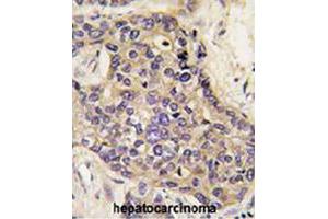 Formalin-fixed and paraffin-embedded human hepatocellular carcinoma reacted with HGF polyclonal antibody  , which was peroxidase-conjugated to the secondary antibody, followed by DAB staining. (HGF 抗体  (AA 521-554))