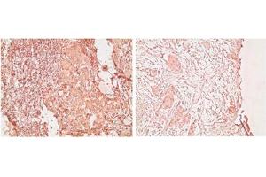 Immunohistochemistry analysis of human Breast tumor tissue stained with Estrogen receptor alpha monoclonal antibody (C-542), at 20 μg/mL. (Estrogen Receptor alpha 抗体  (C-Term))