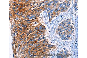 Immunohistochemistry of Human esophagus cancer using CLEC2B Polyclonal Antibody at dilution of 1:50 (CLEC2B 抗体)