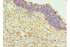 Immunohistochemistry of paraffin-embedded human ovarian cancer using ABIN7159637 at dilution of 1:100 (TET2 抗体  (AA 1833-2002))