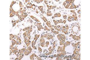 Immunohistochemistry of Human breast cancer using ATPIF1 Polyclonal Antibody at dilution of 1:60 (ATPase Inhibitory Factor 1 抗体)