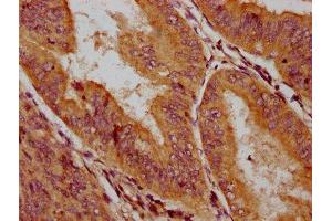 IHC image of ABIN7145611 diluted at 1:200 and staining in paraffin-embedded human endometrial cancer performed on a Leica BondTM system. (HLCS 抗体  (AA 603-714))