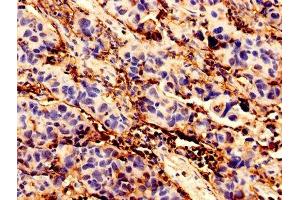 Immunohistochemistry analysis of human bladder cancer using ABIN7145741 at dilution of 1:100 (BCAT1 抗体  (AA 4-276))