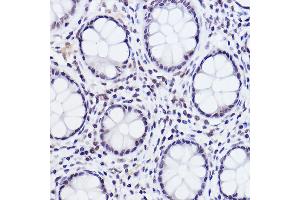 Immunohistochemistry of paraffin-embedded human colon carcinoma using Phospho-c-Jun-S243 Rabbit pAb (ABIN3023576, ABIN3023577, ABIN3023578 and ABIN6225416) at dilution of 1:25 (40x lens). (C-JUN 抗体  (pSer243))