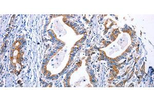 Immunohistochemistry of paraffin-embedded Human gastric cancer using DRD4 Polyclonal Antibody at dilution of 1:30 (DRD4 抗体)