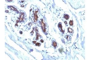 Formalin-fixed, paraffin-embedded human Breast Carcinoma stained with Milk Fat Globule Monoclonal Antibody (EDM45) (MFGE8 抗体)
