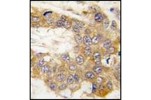 Formalin-Fixed, Paraffin-Embedded human breast carcinoma tissue reacted with Autophagy ATG5 Antibody (N-term) followed which was peroxidase conjugated to the secondary antibody, followed by DAB staining. (ATG5 抗体  (N-Term))