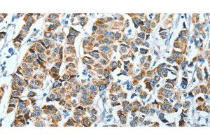 Immunohistochemistry of paraffin-embedded Human breast cancer using ALDH4A1 Polyclonal Antibody at dilution of 1:45 (ALDH4A1 抗体)