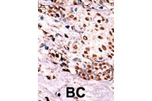 Formalin-fixed and paraffin-embedded human cancer tissue reacted with the primary antibody, which was peroxidase-conjugated to the secondary antibody, followed by AEC staining. (c-MET 抗体  (pTyr1349))