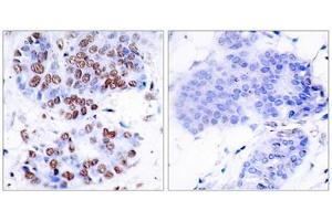 Immunohistochemistry analysis of paraffin-embedded human breast carcinoma tissue, using NF-kappaB p65 (epitope around residue 276) Antibody.