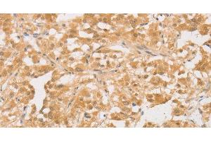 Immunohistochemistry of paraffin-embedded Human thyroid cancer tissue using CD24 Polyclonal Antibody at dilution of 1:40 (CD24 抗体)