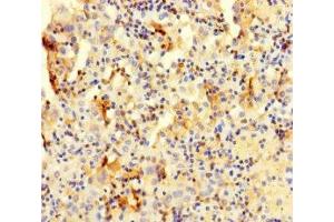 Immunohistochemistry of paraffin-embedded human lung cancer using ABIN7147985 at dilution of 1:100 (COTL1 抗体  (AA 2-142))