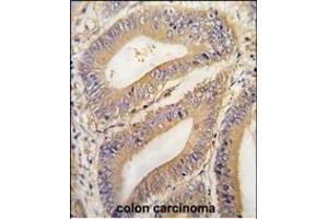 Formalin-fixed and paraffin-embedded human colon carcinoma tissue reacted with PHB2 Antibody (N-term) (ABIN391410 and ABIN2841408) , which was peroxidase-conjugated to the secondary antibody, followed by DAB staining. (Prohibitin 2 抗体  (N-Term))