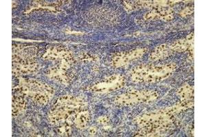 Immunohistochemical staining (Formalin-fixed paraffin-embedded sections) of human lung adenocarcinoma with NKX2-1 monoclonal antibody, clone G21-G . (NKX2-1 抗体  (N-Term))