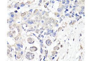 Immunohistochemistry of paraffin-embedded Human breast cancer using BAP1 Polyclonal Antibody at dilution of 1:150 (40x lens). (BAP1 抗体)