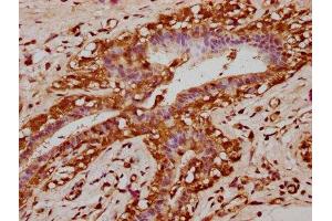 IHC image of ABIN7145515 diluted at 1:200 and staining in paraffin-embedded human breast cancer performed on a Leica BondTM system. (Klotho beta 抗体  (AA 1-130))