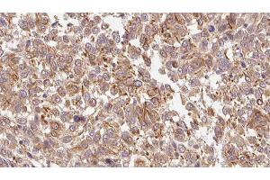 ABIN6278484 at 1/100 staining Human Melanoma tissue by IHC-P. (INHBC 抗体  (C-Term))