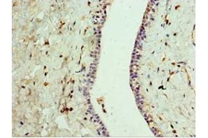 Immunohistochemistry of paraffin-embedded human breast cancer using ABIN7167823 at dilution of 1:100