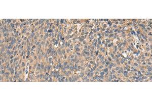 Immunohistochemistry of paraffin-embedded Human cervical cancer tissue using MRPL42 Polyclonal Antibody at dilution of 1:65(x200) (MRPL42 抗体)