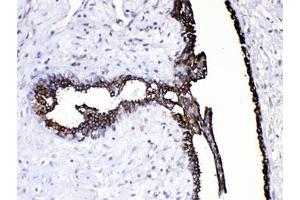 IHC testing of FFPE human breast cancer tissue with CASP8 antibody at 1ug/ml. (Caspase 8 抗体  (AA 410-449))