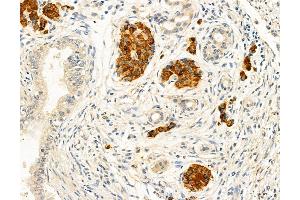 ABIN6263468 and ABIN6272966 at 1/100 staining Human pancreatic cancer by IHC-P. (MYH7 抗体  (C-Term))