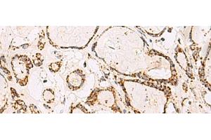 Immunohistochemistry of paraffin-embedded Human thyroid cancer tissue using ATP5O Polyclonal Antibody at dilution of 1:90(x200) (ATP5O 抗体)