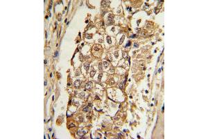 Formalin-fixed and paraffin-embedded human breast carcinoma with MCL1 Antibody (BH3 Domain Specific), which was peroxidase-conjugated to the secondary antibody, followed by DAB staining. (MCL-1 抗体  (AA 191-226))