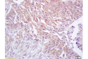 Formalin-fixed and paraffin embedded human lung carcinoma labeled with Rabbit Anti CDC37 Polyclonal Antibody, Unconjugated (ABIN706481) at 1:200 followed by conjugation to the secondary antibody and DAB staining (CDC37 抗体  (AA 291-378))