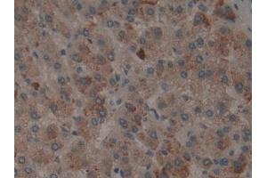 Detection of tPA in Human Liver cancer Tissue using Polyclonal Antibody to Tissue Plasminogen Activator (tPA) (PLAT 抗体)