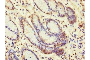 Immunohistochemistry of paraffin-embedded human gastric cancer using ABIN7160637 at dilution of 1:100 (SET Binding Factor 2 抗体  (AA 1585-1813))