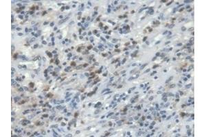 Detection of PIK3Cd in Human Colorectal cancer Tissue using Polyclonal Antibody to Phosphoinositide-3-Kinase Catalytic Delta Polypeptide (PIK3Cd) (PIK3CD 抗体  (AA 774-1044))