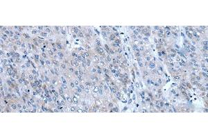 Immunohistochemistry of paraffin-embedded Human liver cancer tissue using ZIC1 Polyclonal Antibody at dilution of 1:65(x200) (ZIC1 抗体)