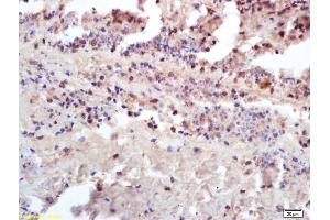 Formalin-fixed and paraffin embedded human kidney carcinoma labeled with Anti-Insulin receptor subunit beta/INSR/CD220 Polyclonal Antibody, Unconjugated (ABIN1714205) at 1:200 followed by conjugation to the secondary antibody and DAB staining