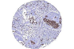 Colon Colorectal adenocarcinoma showing numerous S100A12 positive granulocytes in the stroma and within tumor glands (S100A12 抗体)
