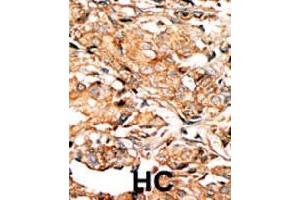 Formalin-fixed and paraffin-embedded human hepatocellular carcinoma tissue reacted with RAD9A (phospho S277) polyclonal antibody  which was peroxidase-conjugated to the secondary antibody followed by AEC staining.