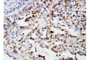 Anti-Ubiquitin antibody, IHC(P) IHC(P): Human Lung Cancer Tissue (Ubiquitin B 抗体  (N-Term))