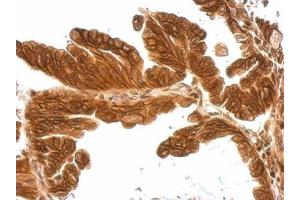 IHC-P Image MMP17 antibody [N2C2], Internal detects MMP17 protein at cytosol and membrane on human gastric cancer by immunohistochemical analysis.