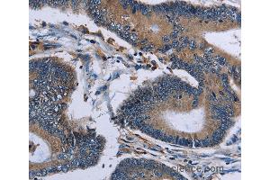 Immunohistochemistry of Human colon cancer using IPO4 Polyclonal Antibody at dilution of 1:50 (Importin 4 抗体)
