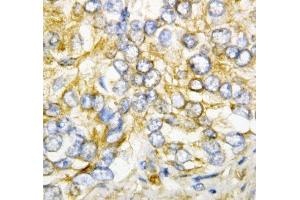 IHC-P: AIMP2 antibody testing of human rectal cancer tissue (AIMP2 抗体  (AA 298-320))