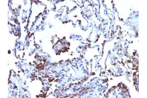 Formalin-fixed, paraffin-embedded human Melanoma metastasized to Lung stained with CD63 Monoclonal Antibody (NKI/C3 + LAMP3/968) (CD63 抗体)