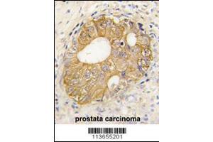Formalin-fixed and paraffin-embedded human prostata carcinoma tissue reacted with CDH3 antibody , which was peroxidase-conjugated to the secondary antibody, followed by DAB staining. (P-Cadherin 抗体  (N-Term))