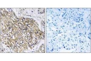 Immunohistochemistry analysis of paraffin-embedded human breast carcinoma tissue, using LPHN2 Antibody. (LPHN2 抗体  (AA 551-600))