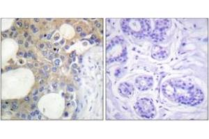 Immunohistochemistry analysis of paraffin-embedded human breast carcinoma tissue, using CD227/MUC1 (Ab-1229) Antibody. (MUC1 抗体  (AA 1201-1250))