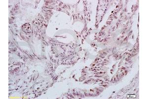 Formalin-fixed and paraffin embedded human colon carcinoma tissue labeled with Anti-LEF-1 Polyclonal Antibody, Unconjugated (ABIN735248) at 1:200 followed by conjugation to the secondary antibody and DAB staining