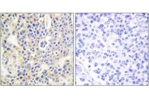 Immunohistochemistry analysis of paraffin-embedded human breast carcinoma, using PKC thet (Phospho-Ser695) Antibody. (PKC theta 抗体  (pSer695))