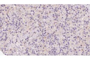 ABIN6273122 at 1/100 staining Human lymph cancer tissue by IHC-P. (HERPUD1 抗体  (N-Term))
