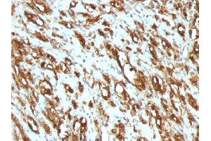 Formalin-fixed, paraffin-embedded human Rhabdomyosarcoma stained with Muscle Specific Actin Mouse Monoclonal Antibody (MSA/953). (ACTA1/ACTA2A/ACTG2 抗体)