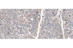 Immunohistochemistry of paraffin-embedded Human liver cancer tissue using THAP10 Polyclonal Antibody at dilution of 1:40(x200) (THAP10 抗体)