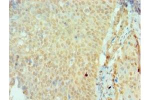 Immunohistochemistry of paraffin-embedded human cervical cancer using ABIN7166161 at dilution of 1:100 (SSX2 抗体  (AA 1-188))