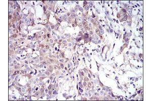 Immunohistochemical analysis of paraffin-embedded esophageal cancer tissues using UBE2C mouse mAb with DAB staining. (UBE2C 抗体  (AA 1-179))